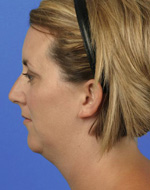 Before Chin Implant Surgery
