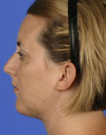 After Chin Implant Surgery