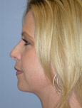 After Double Chin Liposculpture