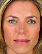 Before a liquid facelift with injectables