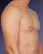 After Male Breast Reduction