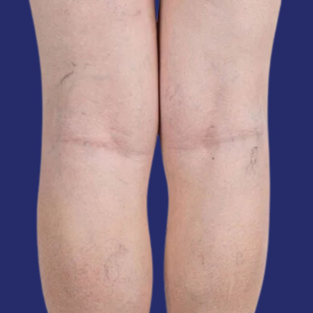 Image of prominent veins on the legs before vascular treatment