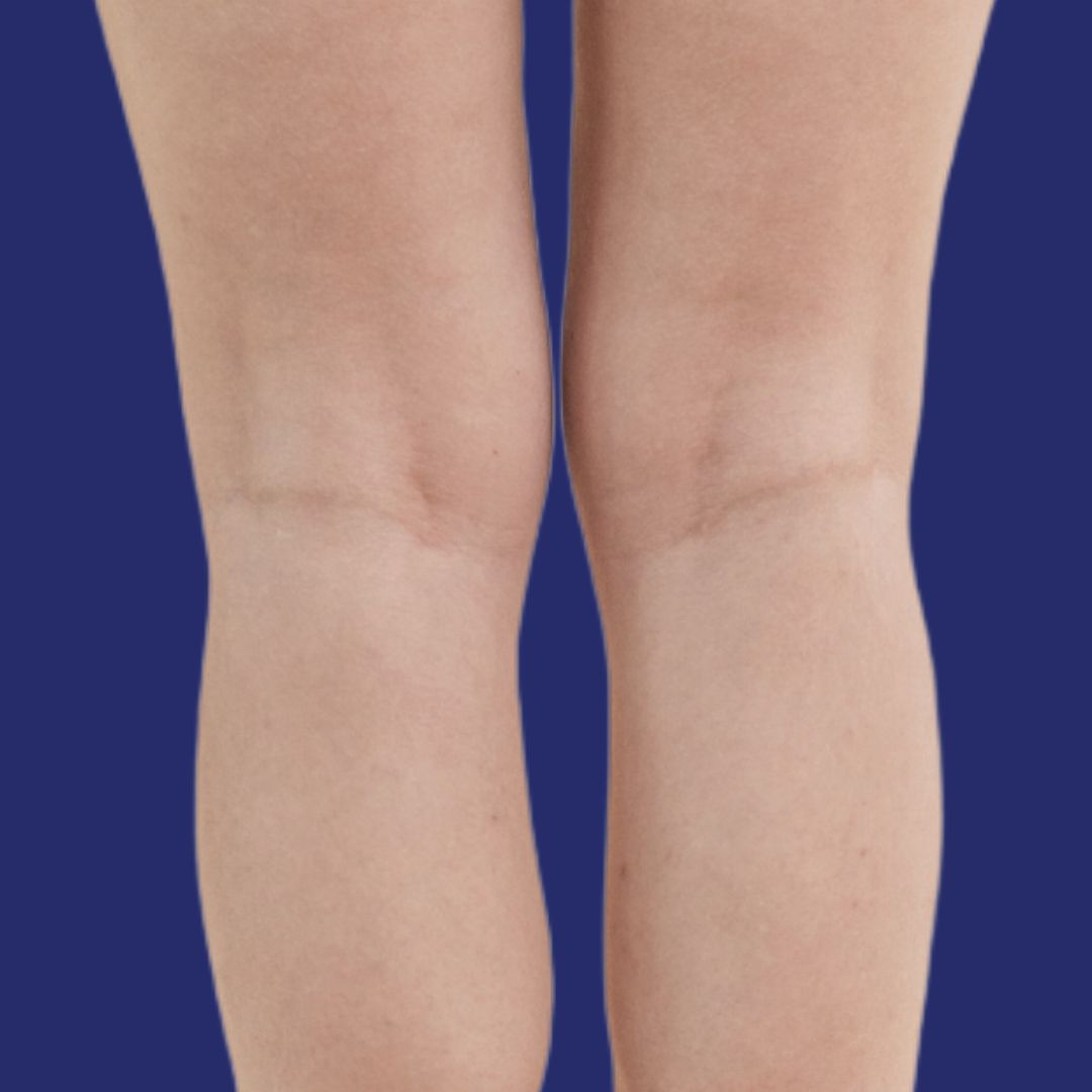 Result of smoother legs without visible veins after vascular treatment