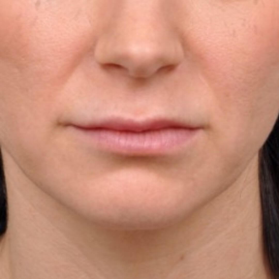 Close-up van lippen vóór de lip-lift-operatie, met subtiele definitie van de bovenlip.