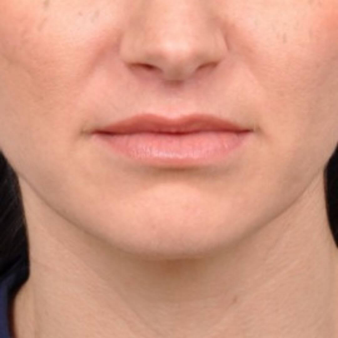 Close-up van lippen na een lip lift ingreep, met verbeterd volume en definitie van de bovenlip.