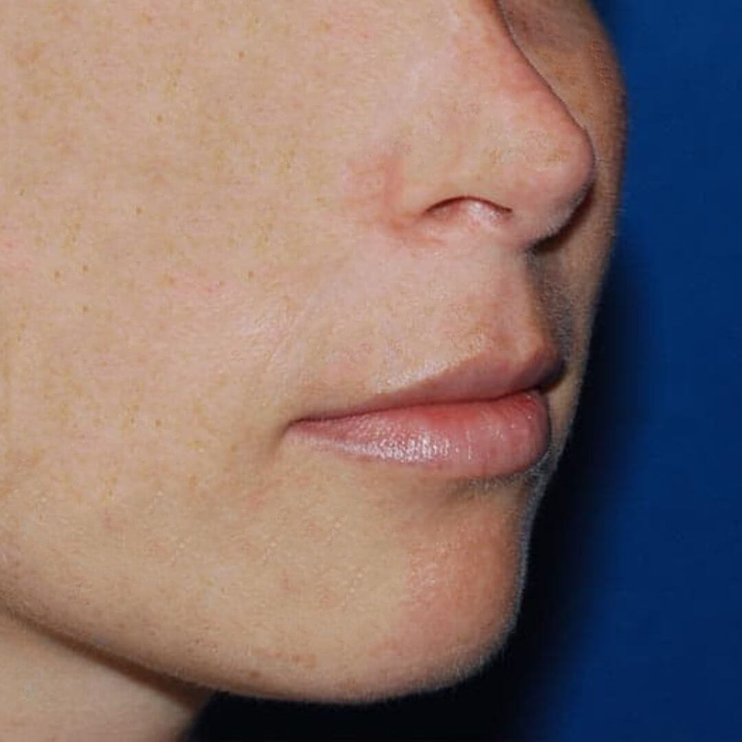 Profilfoto des Gesichts vor der Lip-Lift-Operation, mit einem entspannten Gesichtsausdruck.