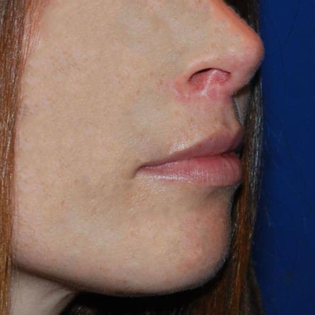Profielweergave van het gezicht na een lip lift, met verjongde lipcontouren