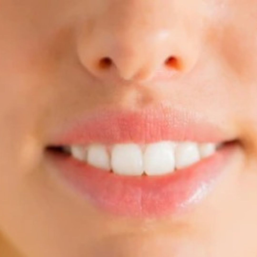 Frontaal beeld van het gezicht na de lip-lift-operatie, met een stralende glimlach