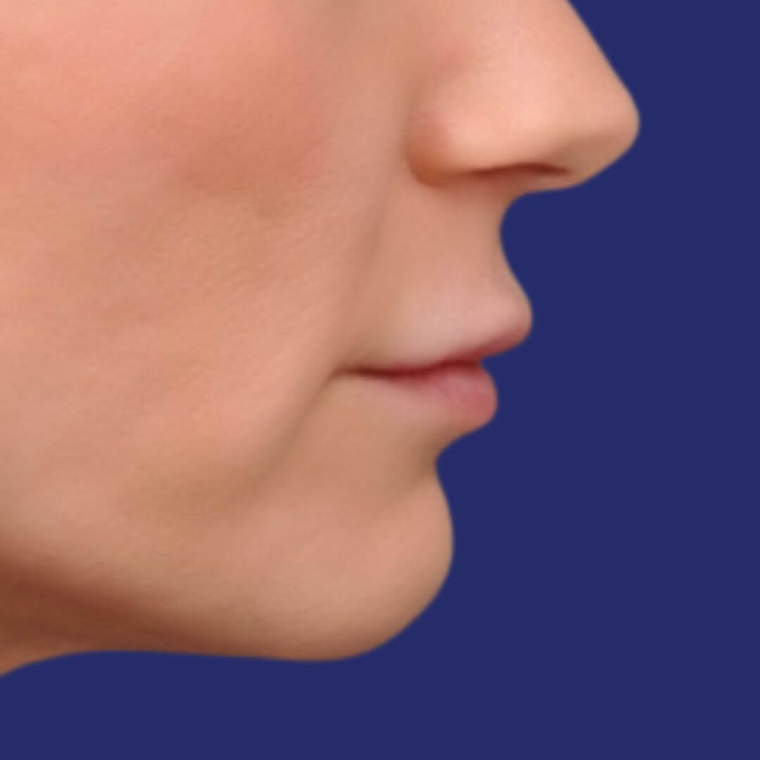Close-upfoto van lippen met een zachte glimlach, waarbij de natuurlijke vorm van de mond vóór de lip-lift wordt benadrukt.
