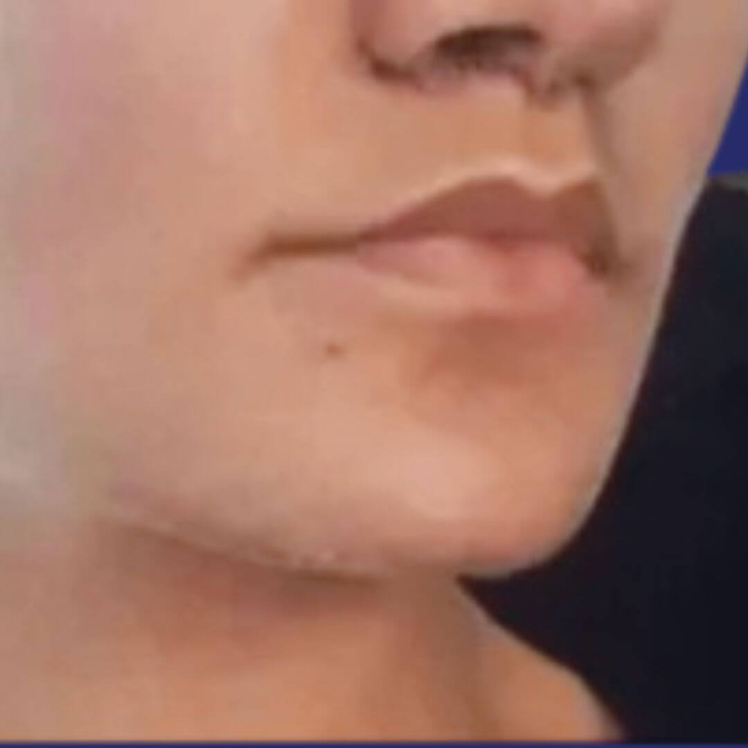 Driekwart zicht op het gezicht na de lip-lift, waarbij verbeterde gezichtsharmonie en meer gedefinieerde lippen worden getoond.