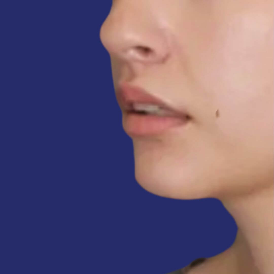 lippen na de lip-lift, met verhoogd volume en verbeterde definitie van de bovenlip.